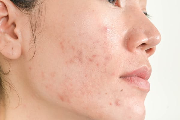 Blemish prone outlet skin